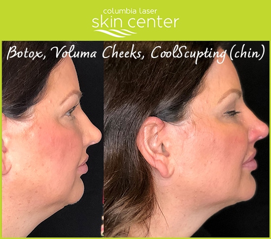 botox, voluma cheeks, coolsculpting facial and neck treatments - available for Hood River, The Dalles and surrounding areas in Oregon and Washington at Columbia Laser Skin Center