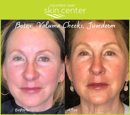 botox, voluma cheeks and juvederm facial treatments - available for Hood River, The Dalles and surrounding areas in Oregon and Washington at Columbia Laser Skin Center