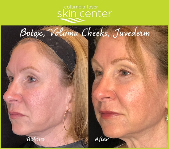 CLSC - botox, voluma cheeks and juvederm facial treatments - available for Hood River, The Dalles and surrounding areas in Oregon and Washington at Columbia Laser Skin Center