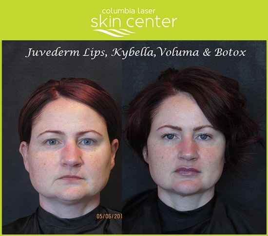 Total Transformations non-surgical face and neck treatments at CLSC - available for Hood River, The Dalles and surrounding areas in Oregon and Washington at Columbia Laser Skin Center