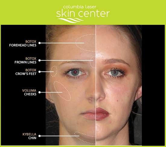 CLSC Before and After - Total Transformations aesthetic treatments - available for Hood River, The Dalles and surrounding areas in Oregon and Washington at Columbia Laser Skin Center