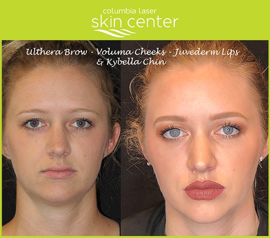 Total Transformations (Ulthera, Voluma, Juvederm and Kybella) aesthetic treatments - available for Hood River, The Dalles and surrounding areas in Oregon and Washington at Columbia Laser Skin Center