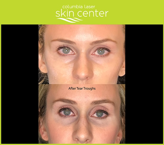 juvederm voluma xc under eye treatments - available for Hood River, The Dalles and surrounding areas in Oregon and Washington at Columbia Laser Skin Center