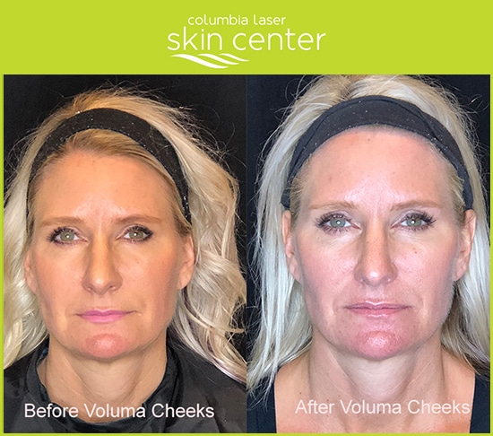 Voluma Cheek Treatment - available for Hood River, The Dalles and surrounding areas in Oregon and Washington at Columbia Laser Skin Center - serving Oregon and Washington