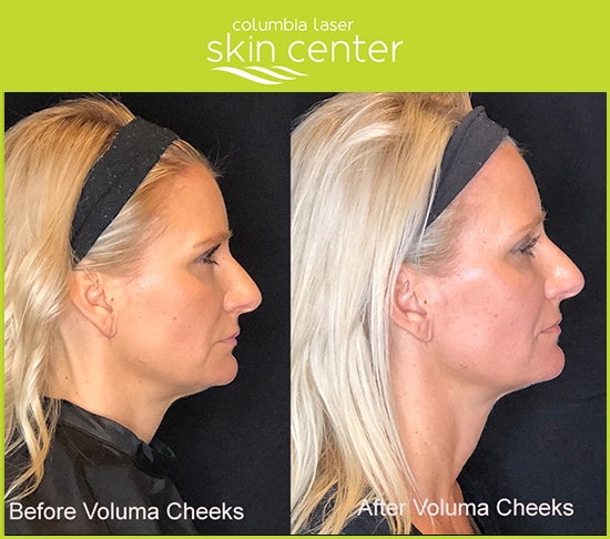 Voluma Cheek Treatment - available for Hood River, The Dalles and surrounding areas in Oregon and Washington at Columbia Laser Skin Center