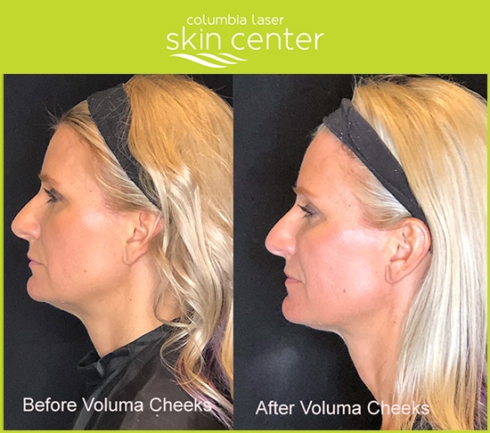 CLSC Voluma Cheek Treatment - available for Hood River, The Dalles and surrounding areas in Oregon and Washington at Columbia Laser Skin Center