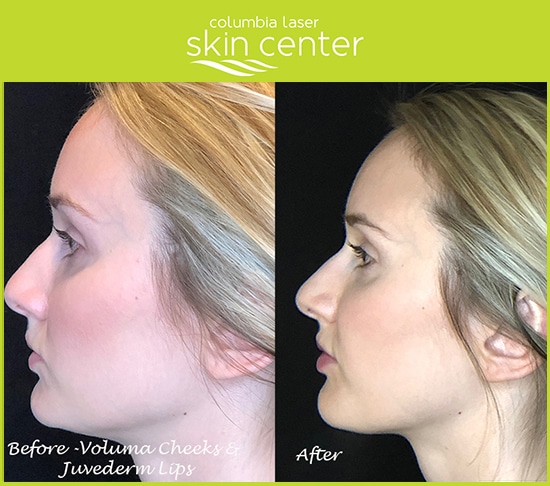 juvederm voluma xc under eye treatments - available for Hood River, The Dalles and surrounding areas in Oregon and Washington at Columbia Laser Skin Center