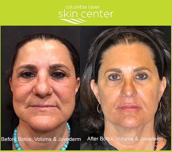 Voluma Botox and juvederm facial treatments - available for Hood River, The Dalles and surrounding areas in Oregon and Washington at Columbia Laser Skin Center
