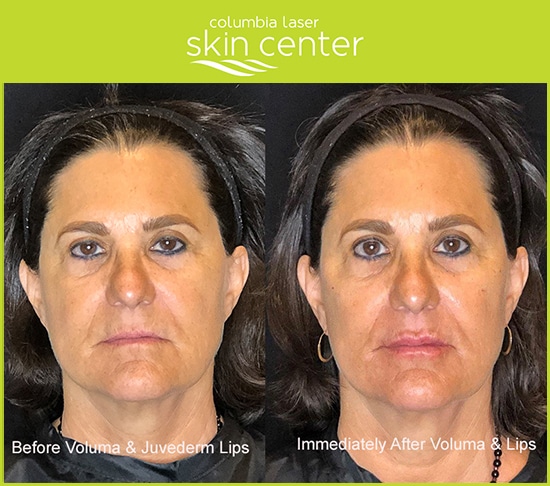 Voluma, Botox and Juvederm for the lips - available for Hood River, The Dalles and surrounding areas in Oregon and Washington at Columbia Laser Skin Center