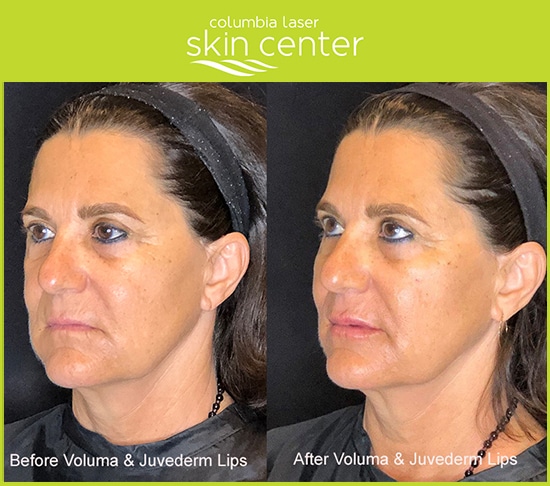 Voluma, Botox and juvederm lip treatments for Lips - available for Hood River, The Dalles and surrounding areas in Oregon and Washington at Columbia Laser Skin Center