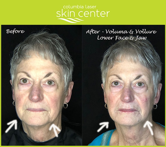 Voluma and Vollure by CLSC - lower face and jaw repair - available for Hood River, The Dalles and surrounding areas in Oregon and Washington at Columbia Laser Skin Center