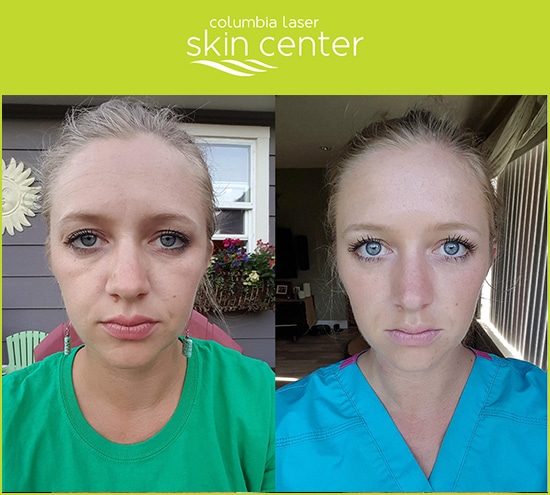 Botox Before and After - available for Hood River, The Dalles and surrounding areas in Oregon and Washington at Columbia Laser Skin Center