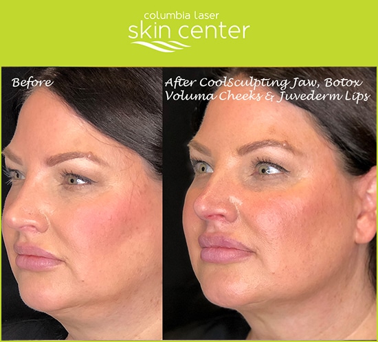 Before and After Photos of our Aesthetic Treatments