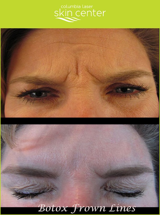 Botox Frown Line Repair at Columbia Laser Skin Center - available for Hood River, The Dalles and surrounding areas in Oregon and Washington