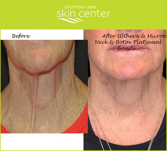 CLSC neck treatments - available for Hood River, The Dalles and surrounding areas in Oregon and Washington at Columbia Laser Skin Center