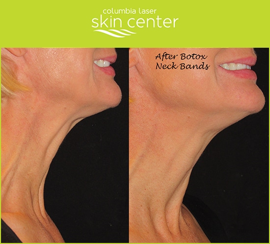 non surgical neck repair - available for Hood River, The Dalles and surrounding areas in Oregon and Washington at Columbia Laser Skin Center