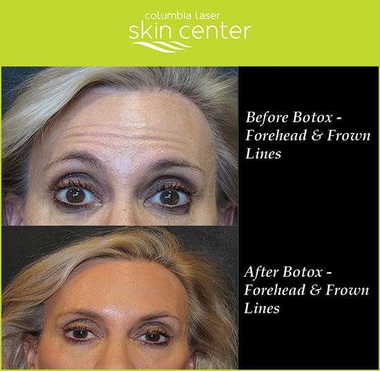 Botox Frown Line Repair - available for Hood River, The Dalles and surrounding areas in Oregon and Washington at Columbia Laser Skin Center