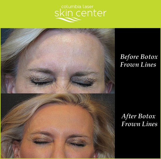 CLSC Botox Frown Line Repair - available for Hood River, The Dalles and surrounding areas in Oregon and Washington at Columbia Laser Skin Center