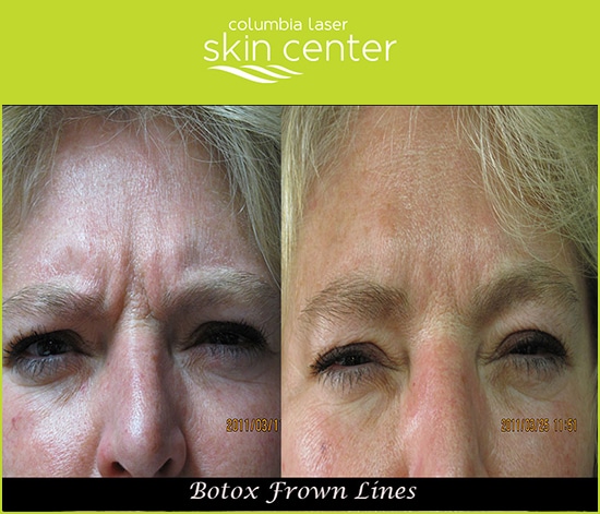 Frown Line Repair with Botox - available for Hood River, The Dalles and surrounding areas in Oregon and Washington at Columbia Laser Skin Center