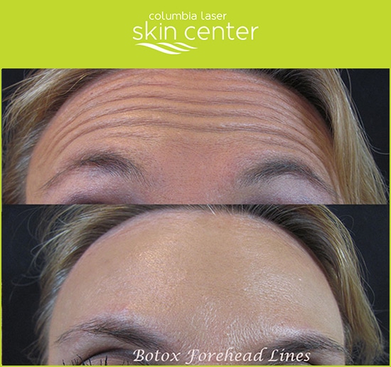 Botox Forehead Line repair - available for Hood River, The Dalles and surrounding areas in Oregon and Washington at Columbia Laser Skin Center