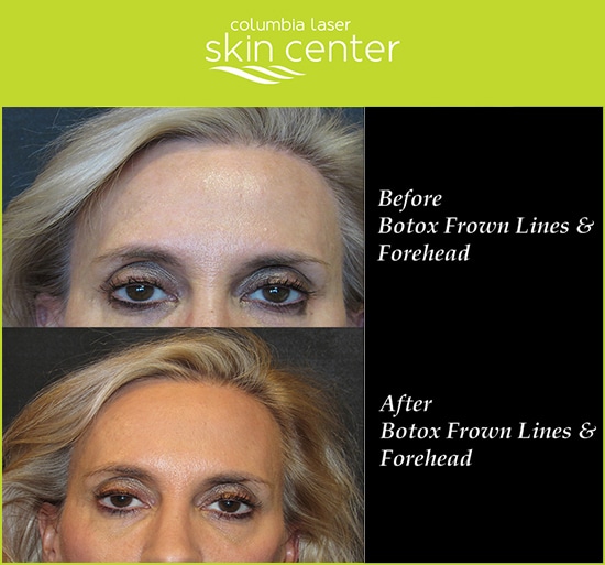 Botox Frown Line Treatments - available for Hood River, The Dalles and surrounding areas in Oregon and Washington at Columbia Laser Skin Center