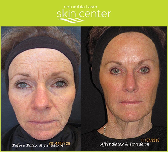 Before and After - Juvederm and Botox