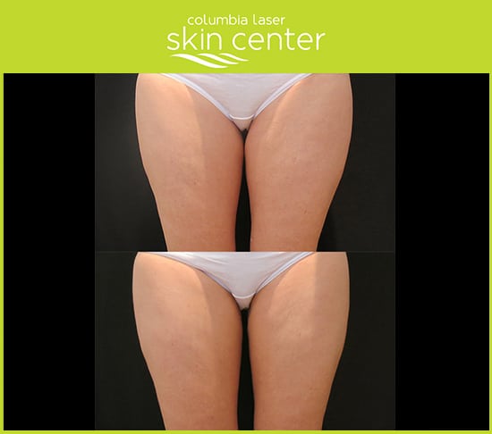 CoolSculpting Leg fix - available for Hood River, The Dalles and surrounding areas in Oregon and Washington at Columbia Laser Skin Center