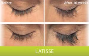 Latisse - Before and After Columbia Laser Skin Center