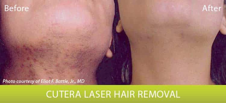 Laser Hair Reduction - Before and After | Columbia Laser Skin Center