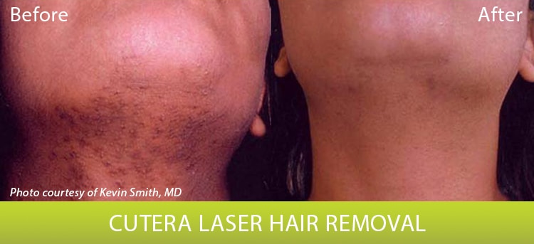 Laser Hair Reduction - Before and After | Columbia Laser Skin Center