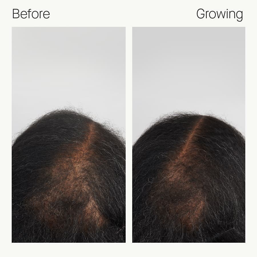 Nutrafol - Before and After | Columbia Laser Skin Center