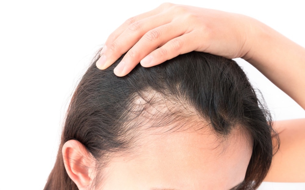 Hair Restoration Treatments