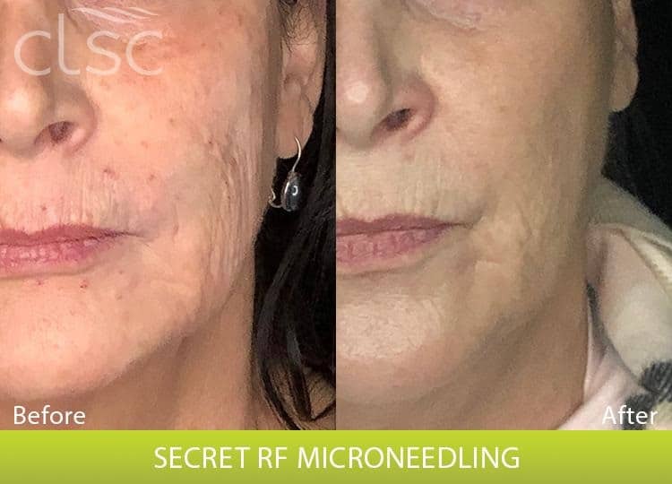 Before and After Photos of Our Secret RF Microneedling Patient