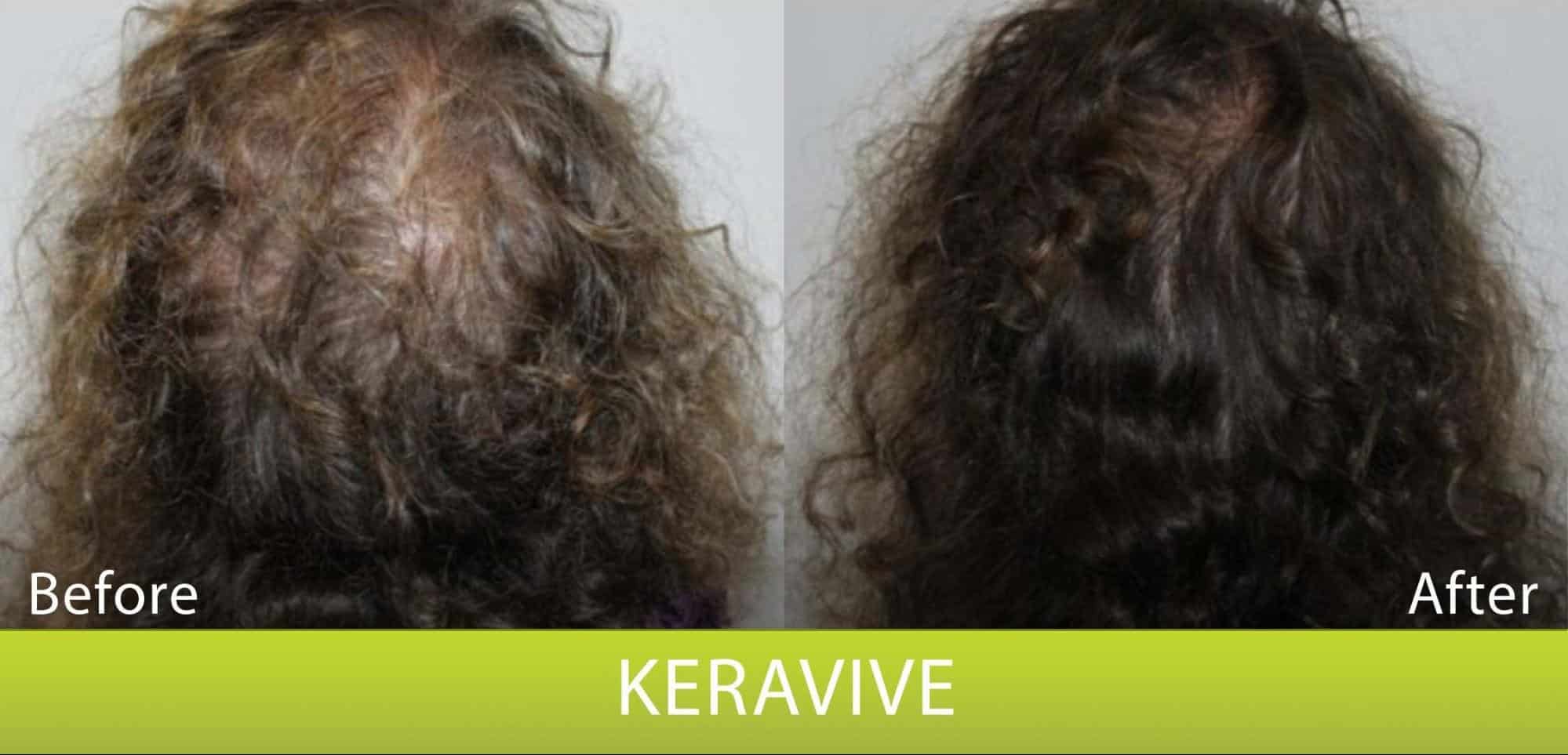 Hair Growth with Keravive Scalp Treatment! Columbia Laser Skin