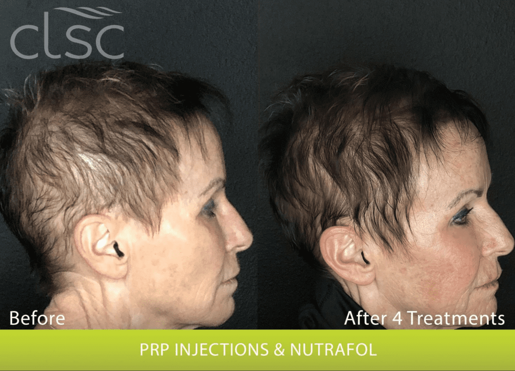 prp injections for women
