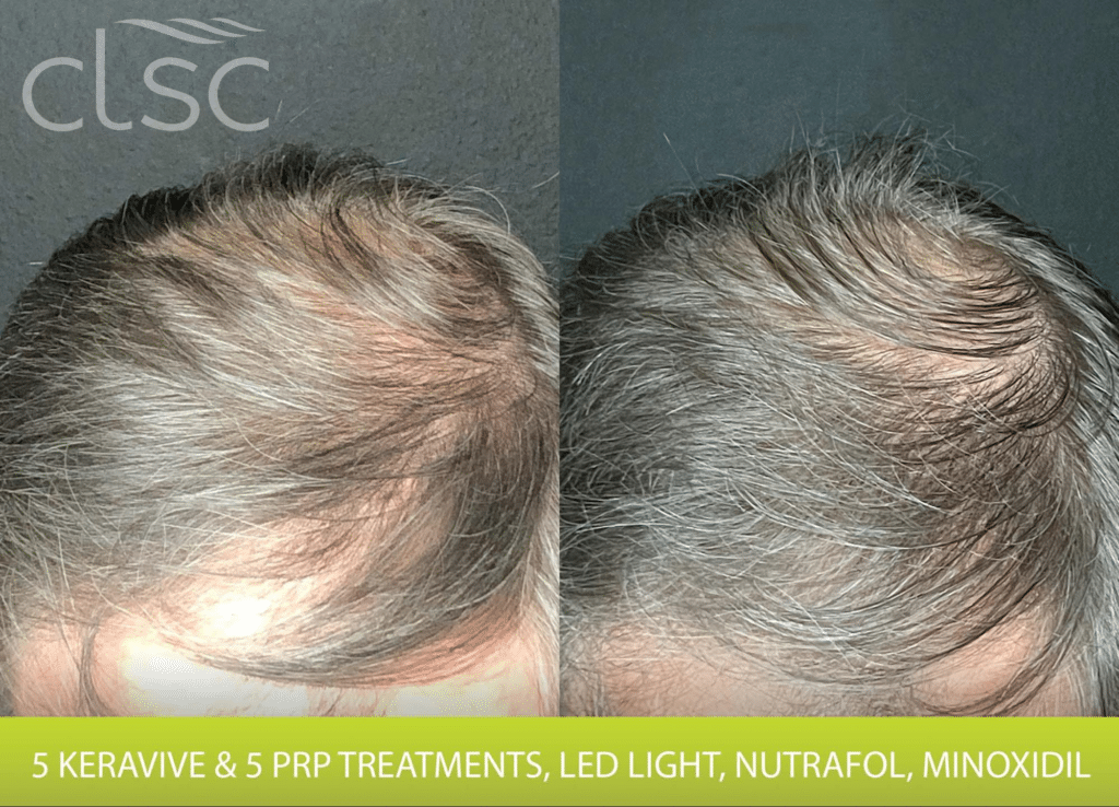 prp 5 treatments hair growth