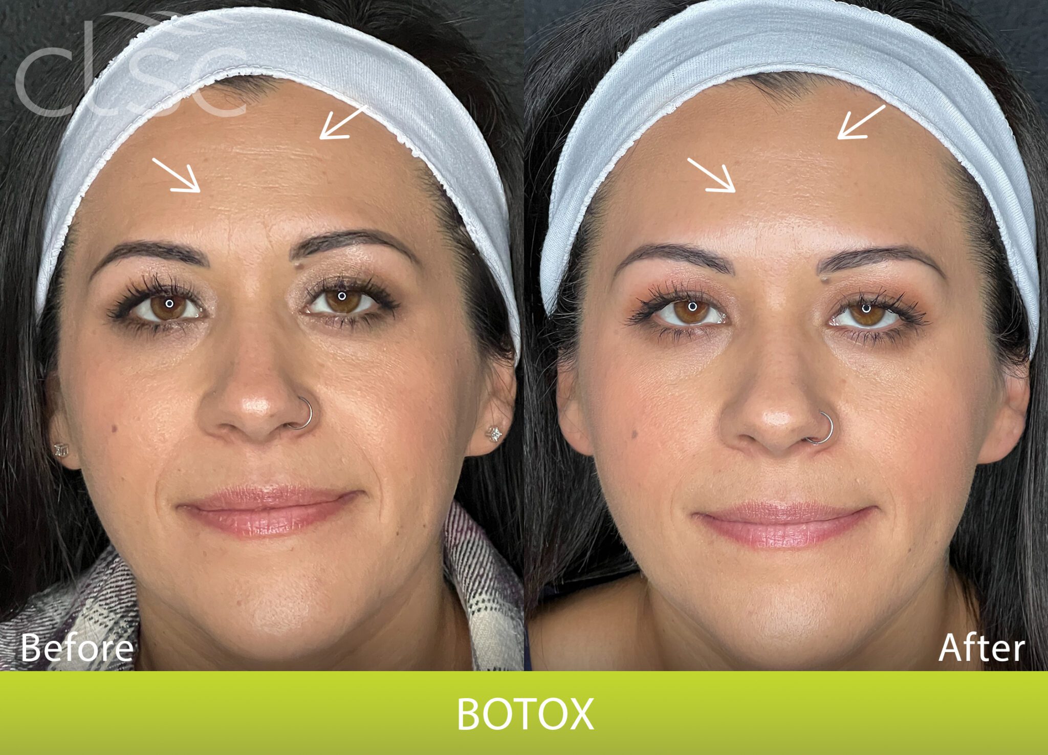 Botox in The Dalles, OR | Columbia Laser Skin Center