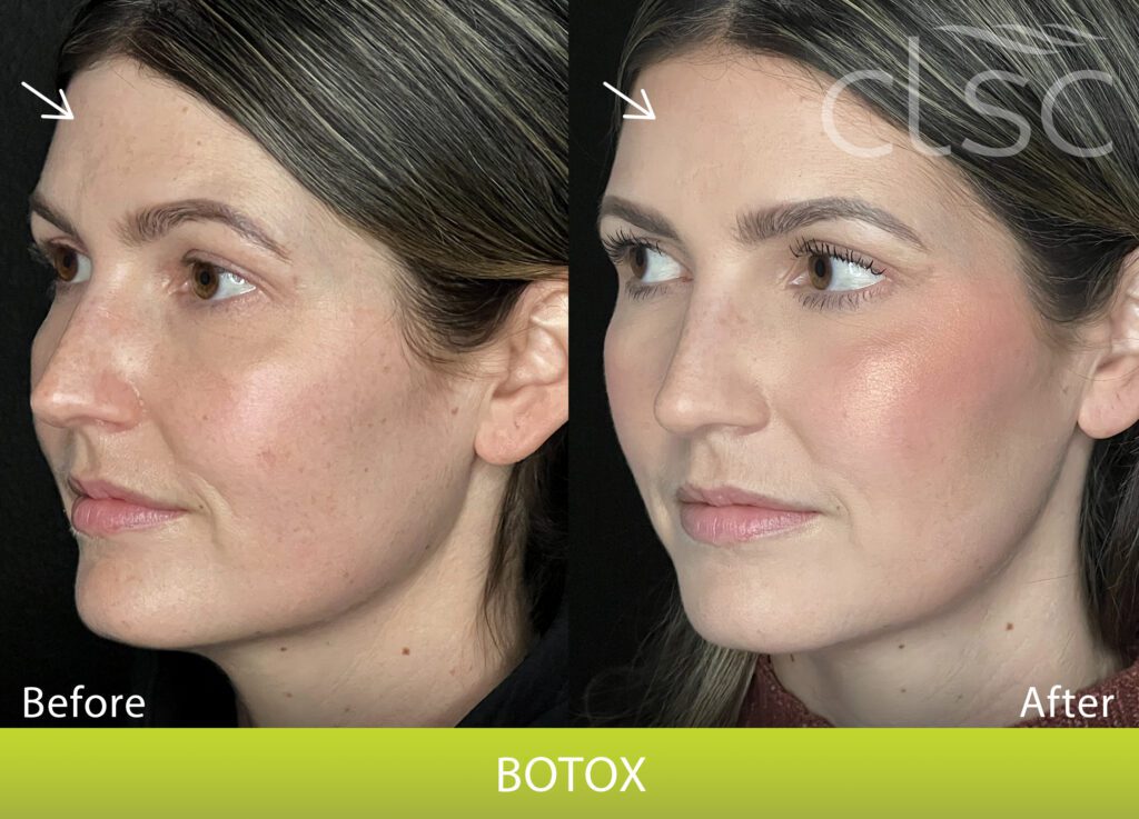 Botox in The Dalles, OR | Columbia Laser Skin Center