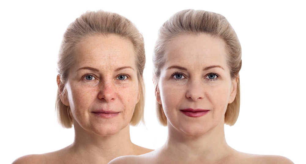 The Process of Getting Wrinkle Relaxer Injections: What to Expect | Columbia Laser Skin Center