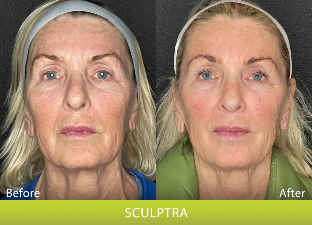 BeforeAndAfterPhoto_Sculptra_HightRes_Female2_Frontal_noArrows