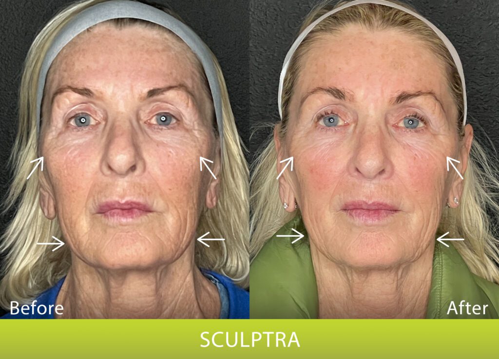 BeforeAndAfterPhoto_Sculptra_HightRes_Female2_Frontal_withArrows