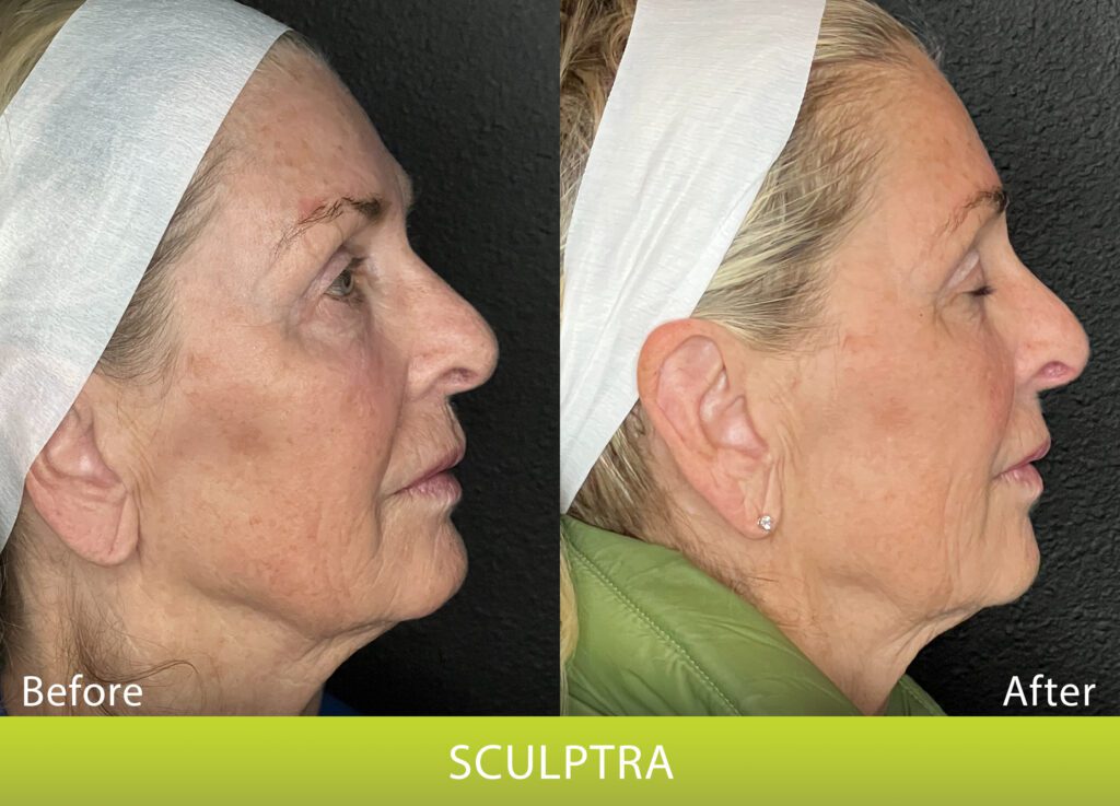 BeforeAndAfterPhoto_Sculptra_HightRes_Female2_RightLateral