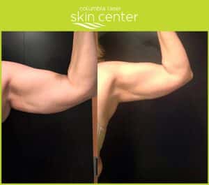 columbia-laser-skin-center-before-and-after-coolsculpting-arms