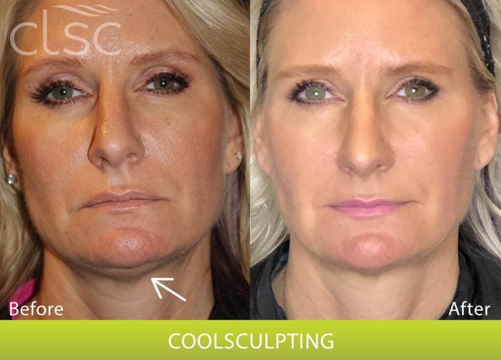 CoolSculpting_Chin_Angie_Front_HighRes