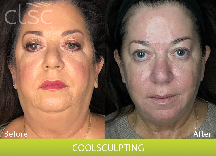 CoolSculpting_Face_Female1_Front
