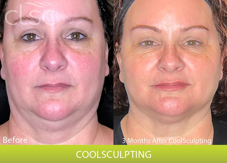 CoolSculpting_Face_Female2_Front