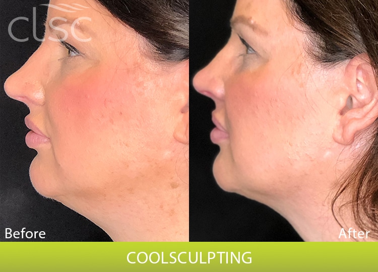 CoolSculpting_Face_Female3_Side