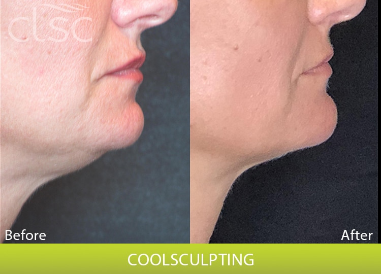 CoolSculpting_Face_Female4_Side