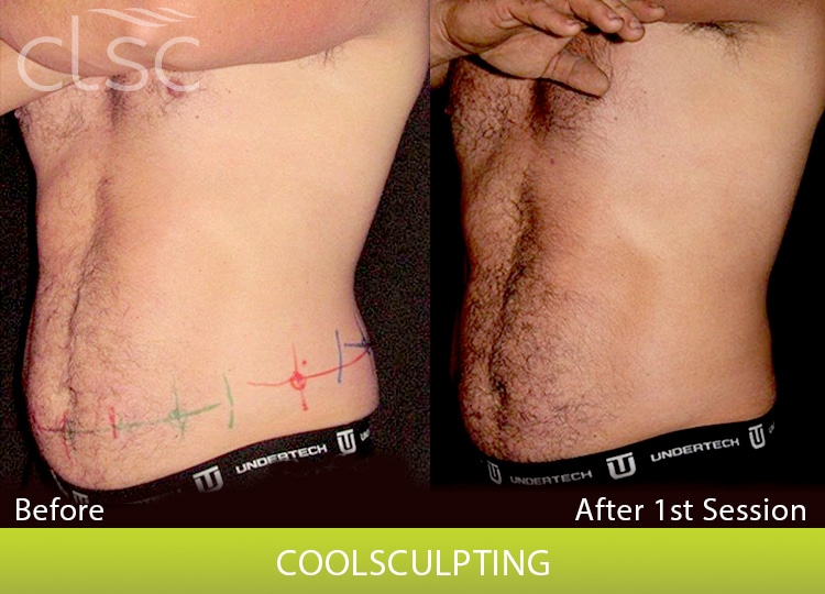 CoolSculpting_Trunk_Male2_Jake_3Qfront