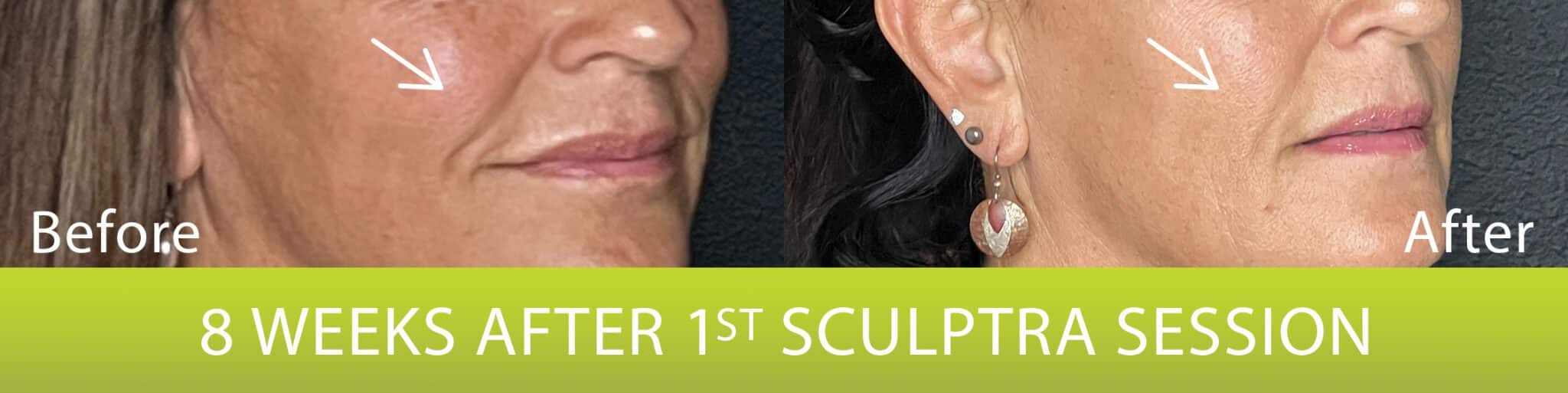 Sculptra Before & After Columbia Laser Skin Center